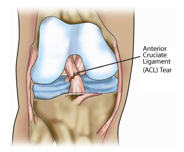 physio for ACL injury - Home Physio Group