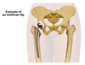 physio to help you recover after a hip replacement - Home Physio Group