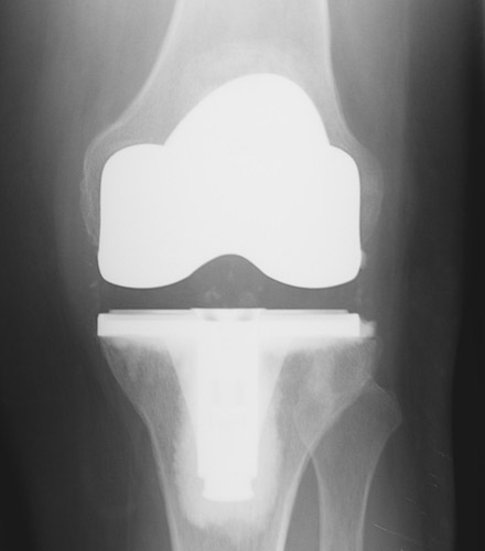 physio to help your recovery from a knee replacement - Home Physio Group