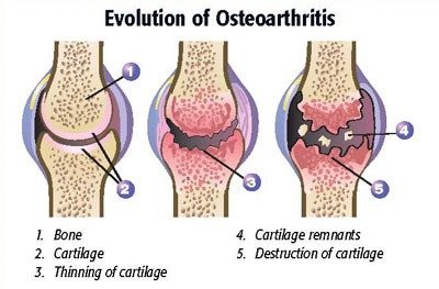 physio to help the pain of osteoarthritis - Home Physio Group