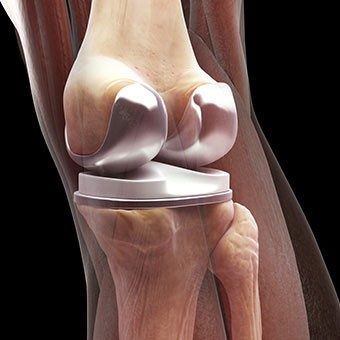 how long do I need to wait for a joint replacement - Home Physio Group