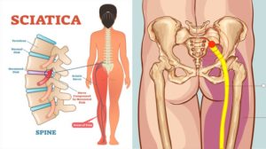 sciatica