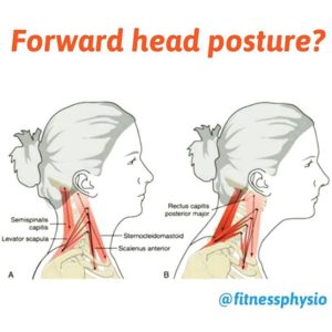forward-head-posture