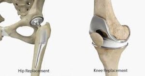 hip-and-knee-replacements